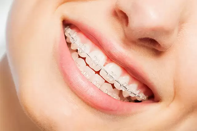 singapore ceramic braces