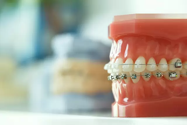 singapore ceramic braces