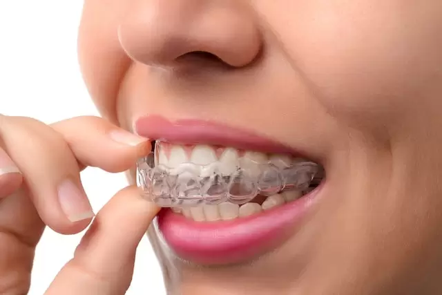 Singapore Ceramic Braces