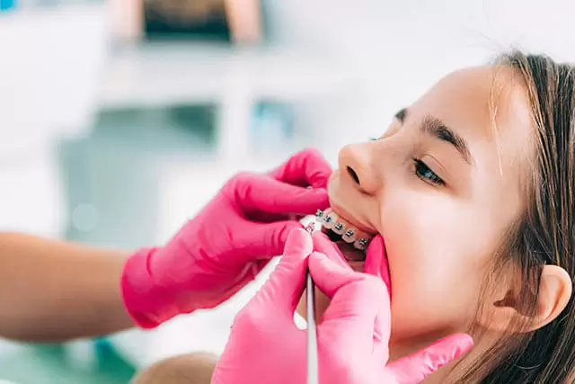 Braces Instalment In Singapore