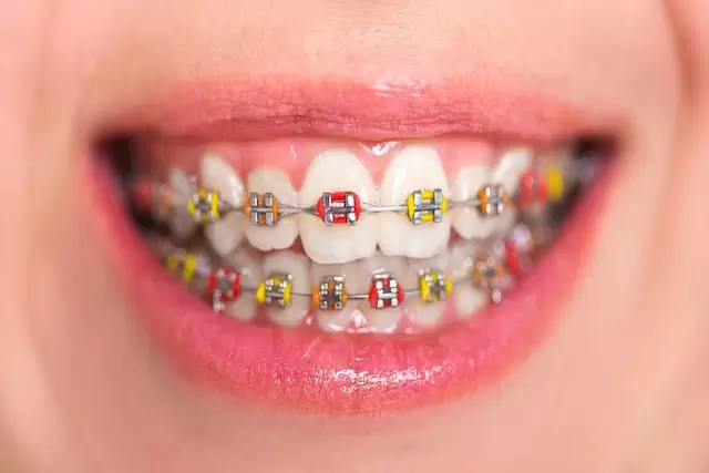 Singapore Ceramic Braces Cost