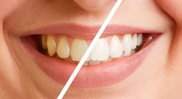 How Much Do Braces Cost, How Much Do Braces Cost In Singapore