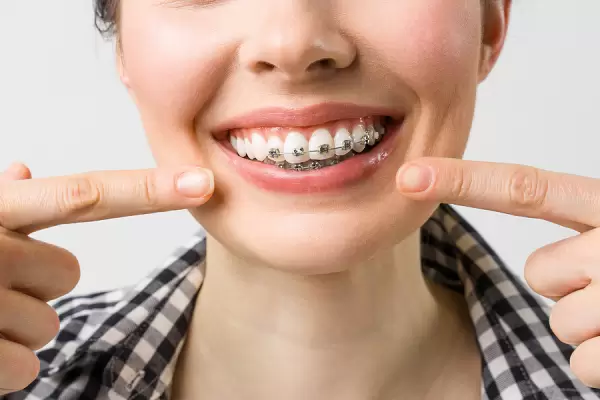 Ceramic Braces, Ceramic Braces Singapore
