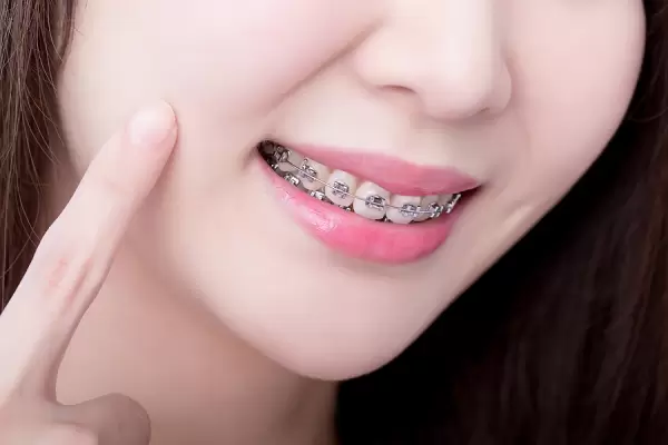 White Spots From Braces: How To Prevent Them From Happening