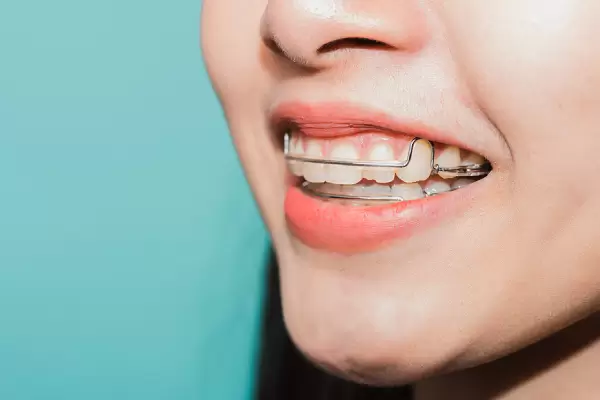5 Common Causes Of Orthodontic Relapse You Must Be Aware Of