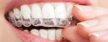 Clear Braces Cost Singapore