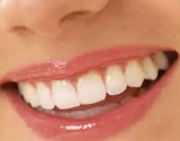 Invisalign Cost Singapore Teeth Whitening