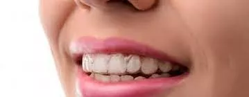 Singapore Invisalign Braces