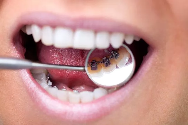 Singapore Lingual Braces