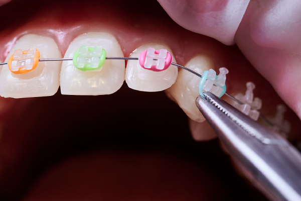 4 Issues You Might Encounter During Your Orthodontic Journey