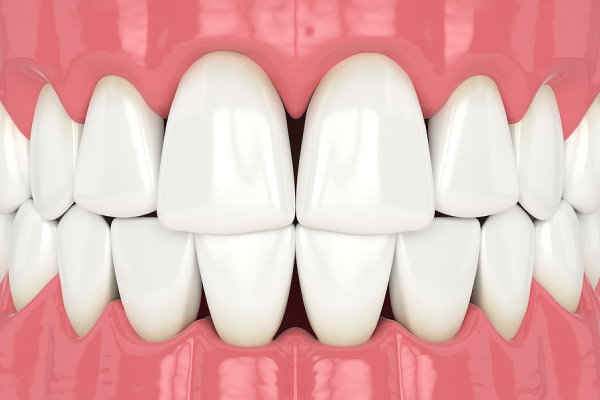 Black Triangles: Will Orthodontic Treatment Cause Them