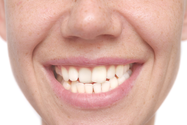 Fixing Just A Single Crooked Tooth Is Not So Simple