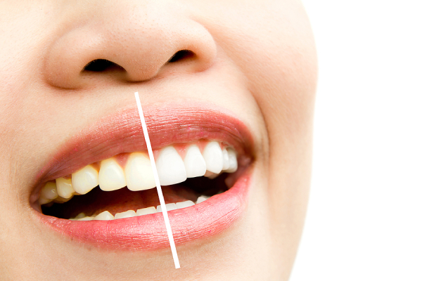 Common Mistakes Most Make When Conducting Teeth Whitening