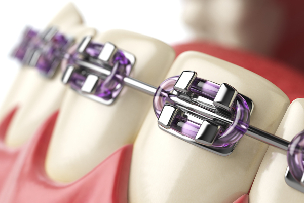 Your Gums Require Additional Care When Wearing Braces