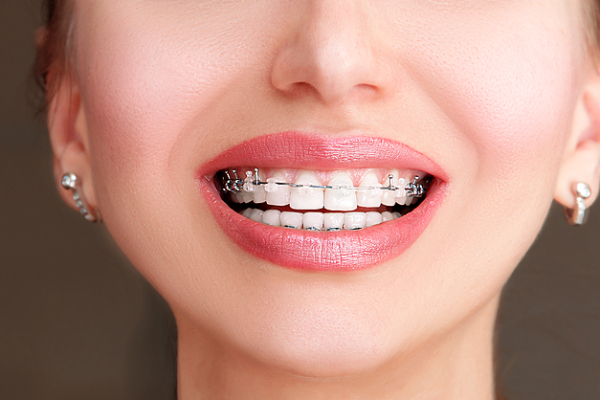 Achieve Straighter & Healthier Teeth With Damon Braces