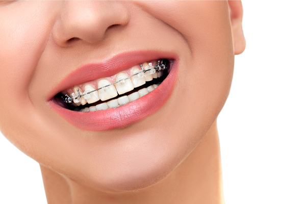 How Braces Can Improve Your Overall Facial Structure